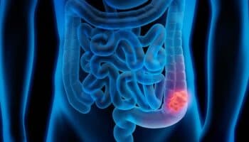 El cáncer colorrectal aumenta en jóvenes de países de ingresos altos