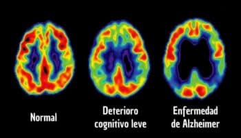 Dan a conocer una forma de detectar Alzheimer en fases tempranas