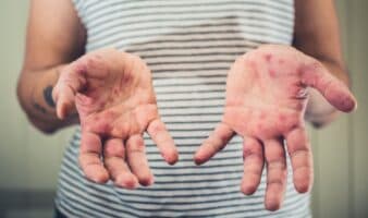 OPS emite alerta epidemiológica por repunte de sarampión en América; urge vacunación