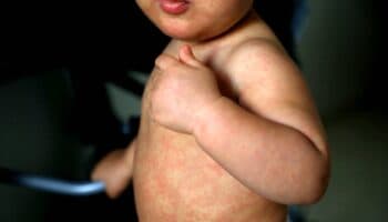 Bebé muere por complicaciones de sarampión en Tlaxcala